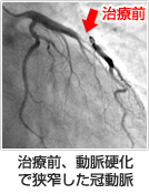 治療前、動脈硬化で狭窄した冠動脈