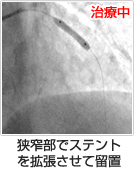 狭窄部でステントを拡張させて留置