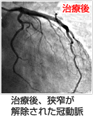 治療後、狭窄が解除された冠動脈